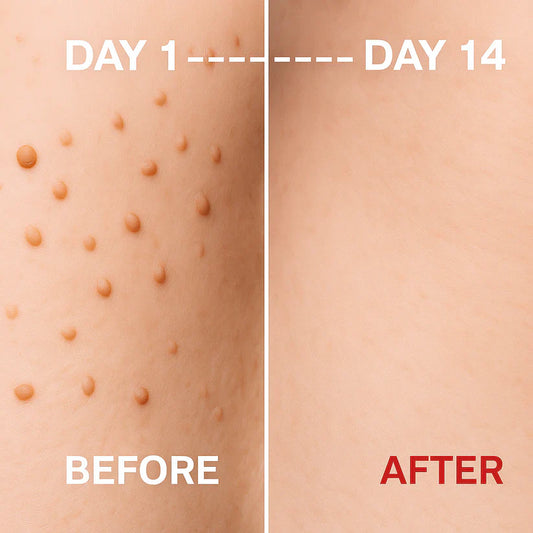 Warts Remover Original Cream – Fast & Gentle Wart Removal Treatment