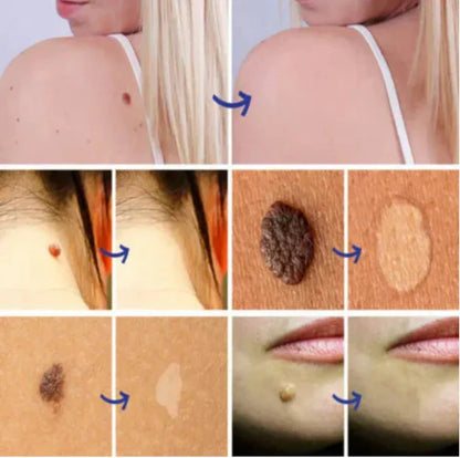 Warts Remover Original Cream – Fast & Gentle Wart Removal Treatment